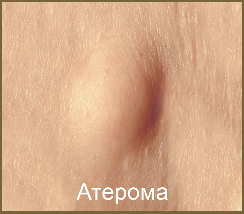Атерома