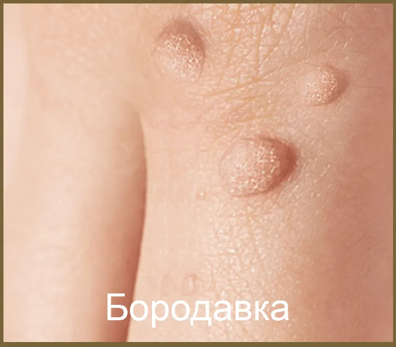 Бородавка