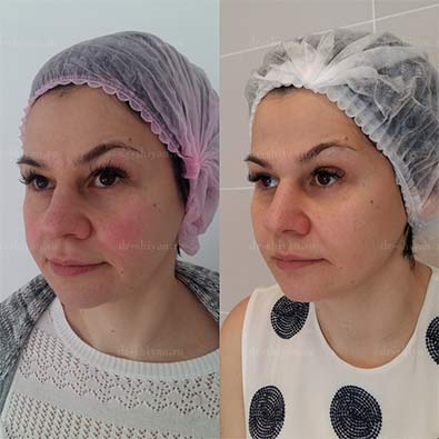 Бьютификация лица до и после 3.1
