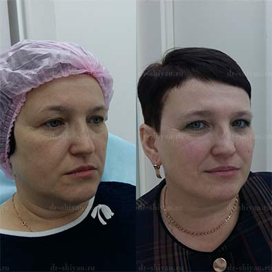 Бьютификация лица до и после 5.2