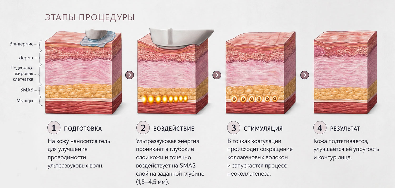4 шага проведения безоперационного SMAS-лифтинга