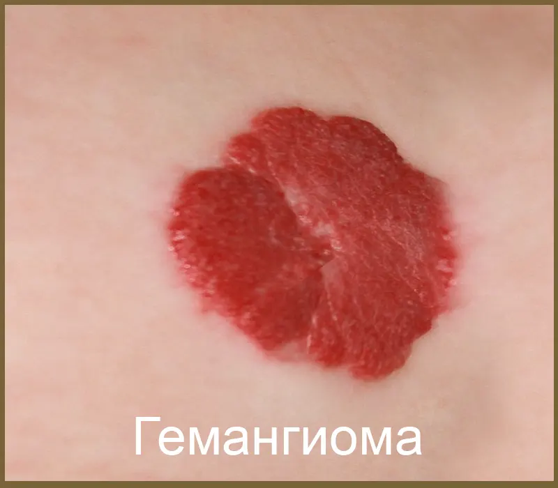 Гемангиома