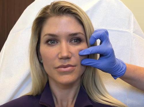 Juvederm Voluma