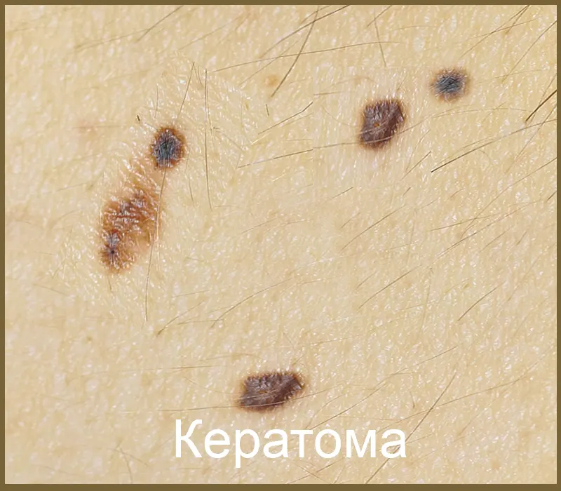 Кератома