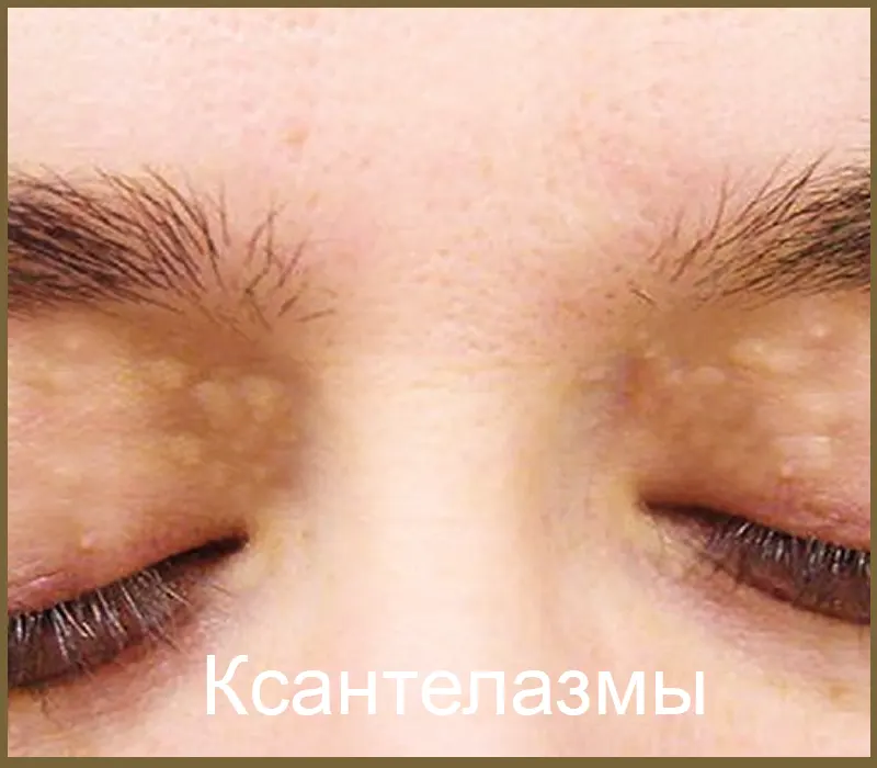 Ксантелазмы