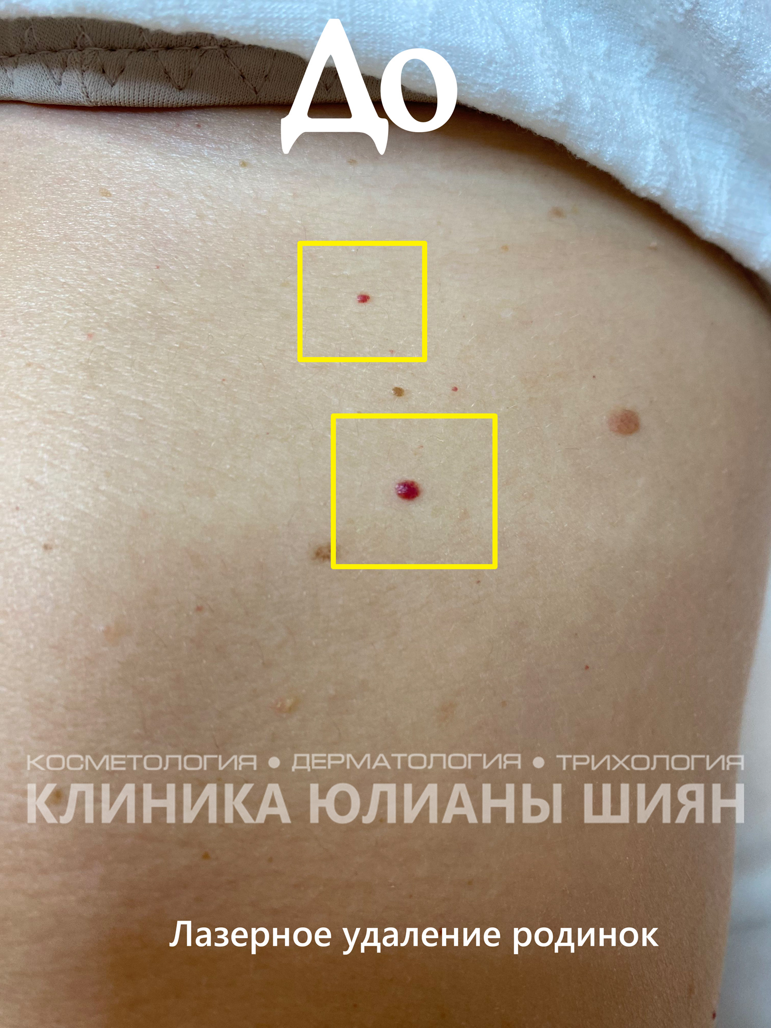 Лазерное удаление красных родинок (до)