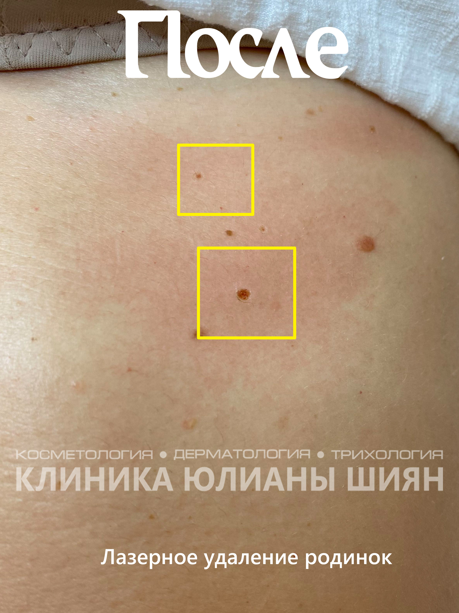 Лазерное удаление красных родинок (после)
