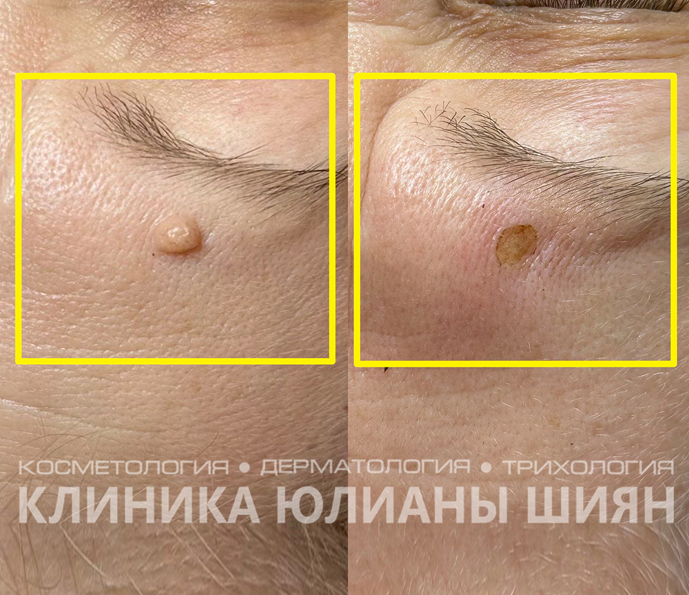 Лазерное удаление новообразований