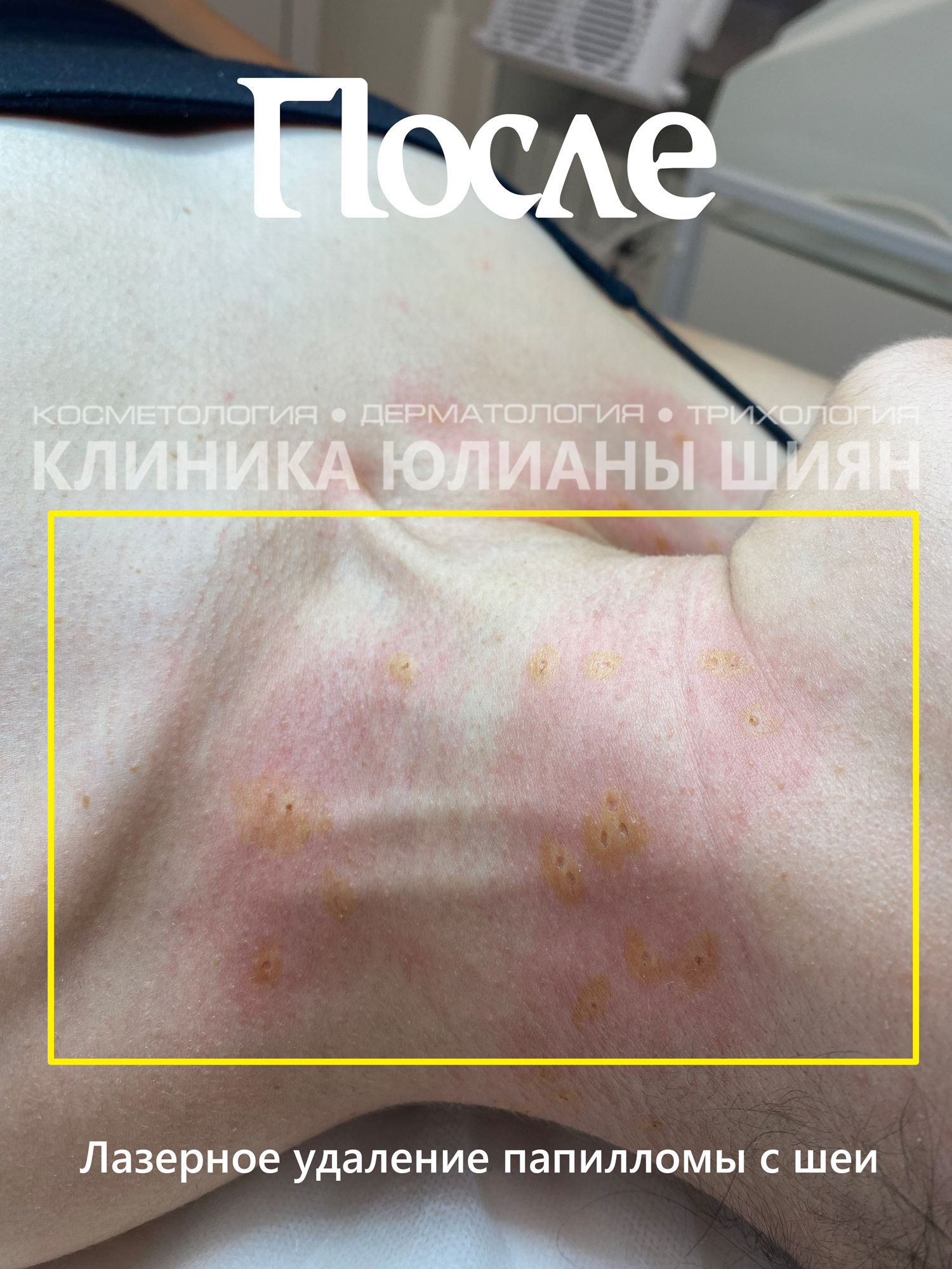 Удаление папилломы лазером с шеи (после)