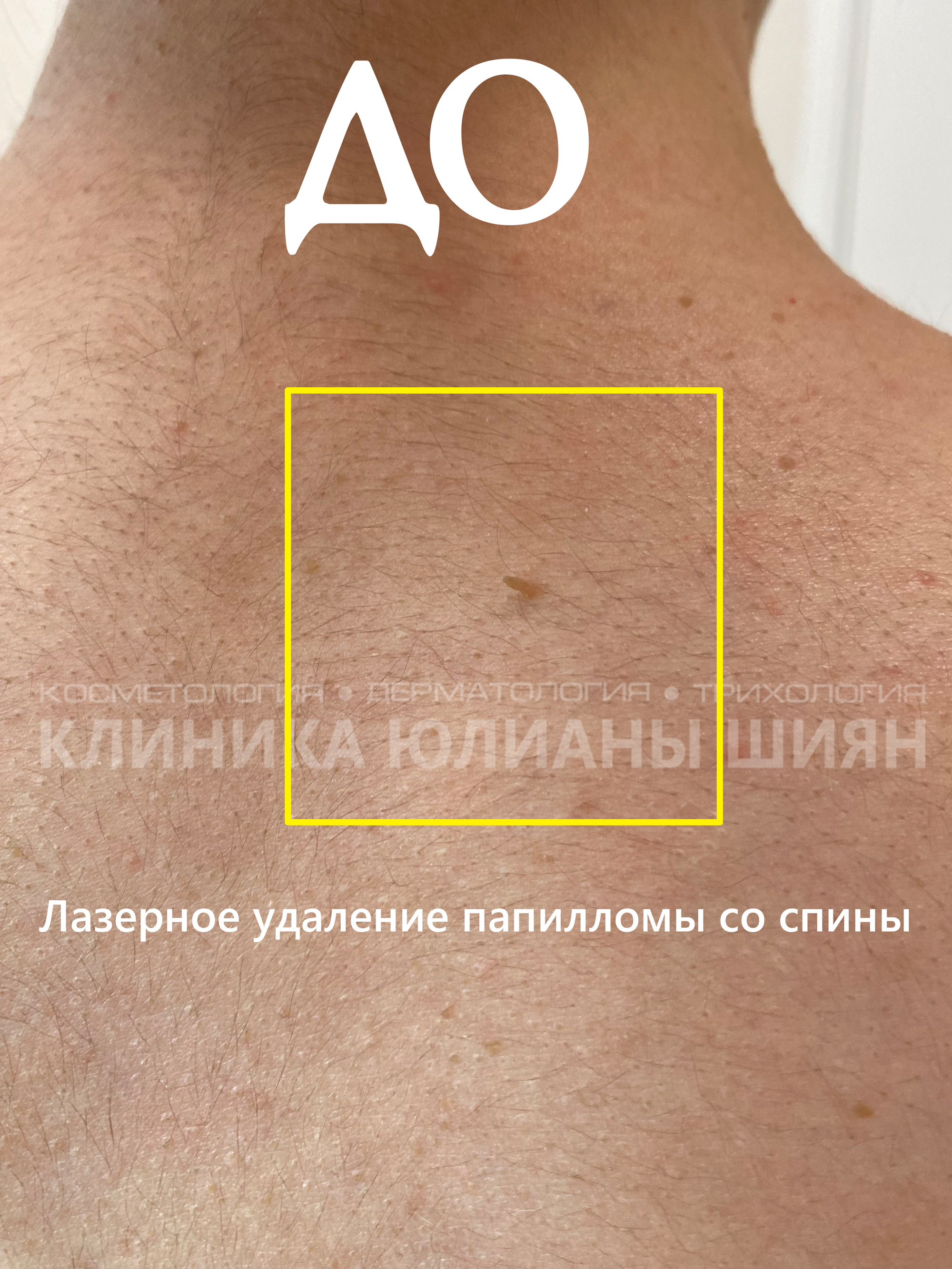 Удаление папилломы лазером со спины (до)