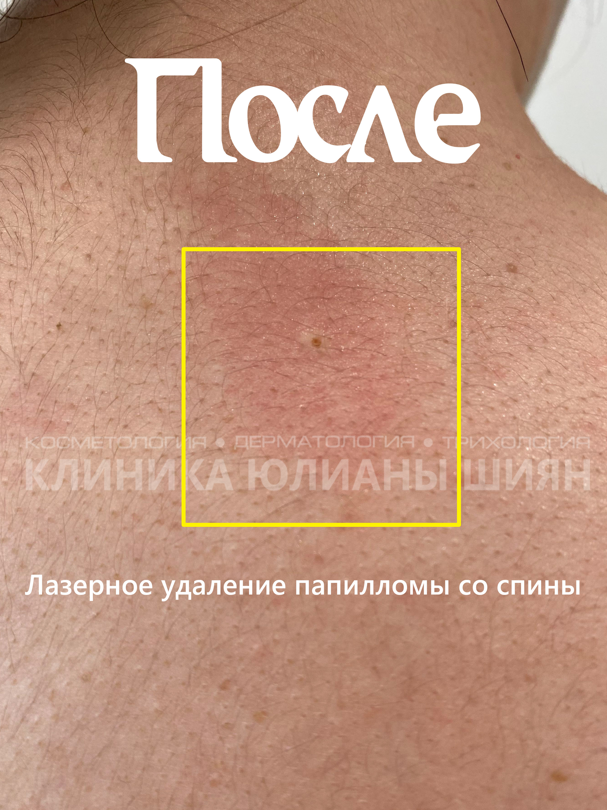 Удаление папилломы лазером со спины (после)
