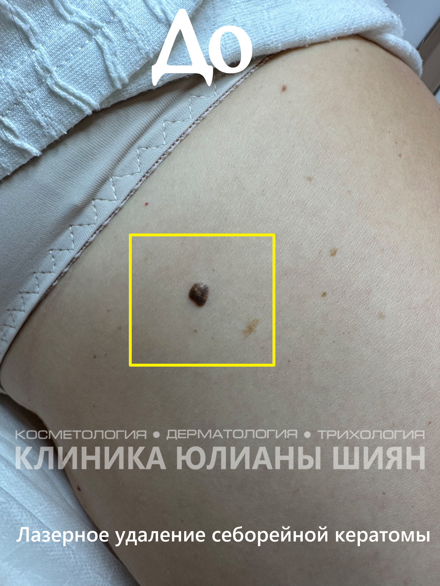 Лазерное удаление себорейной кератомы (до)