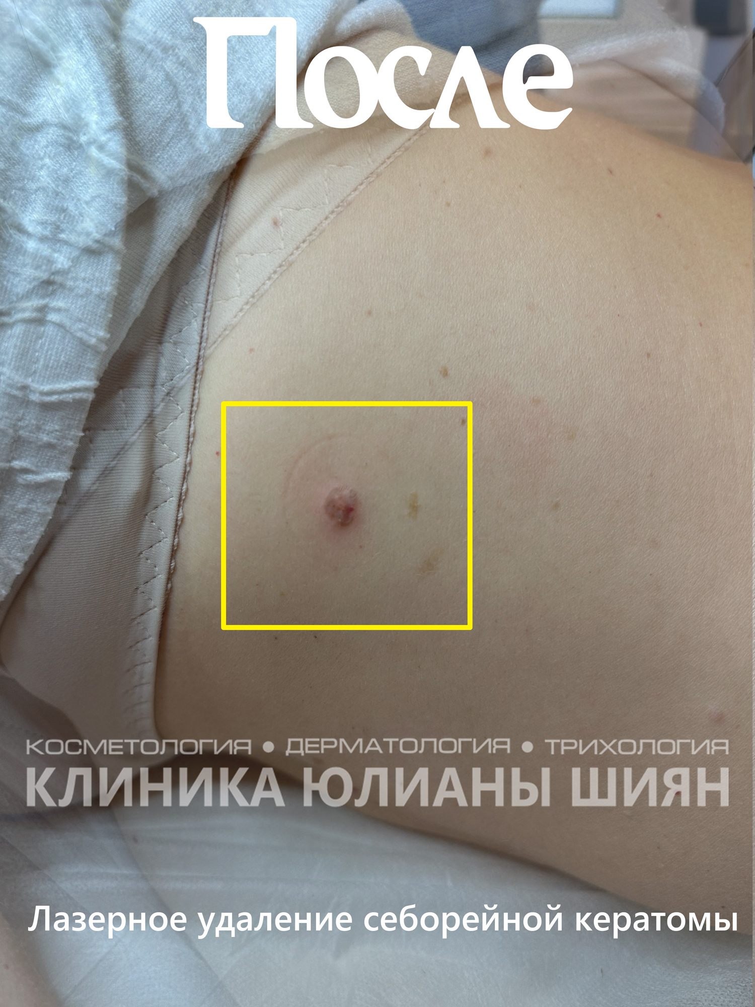 Лазерное удаление себорейной кератомы (после)