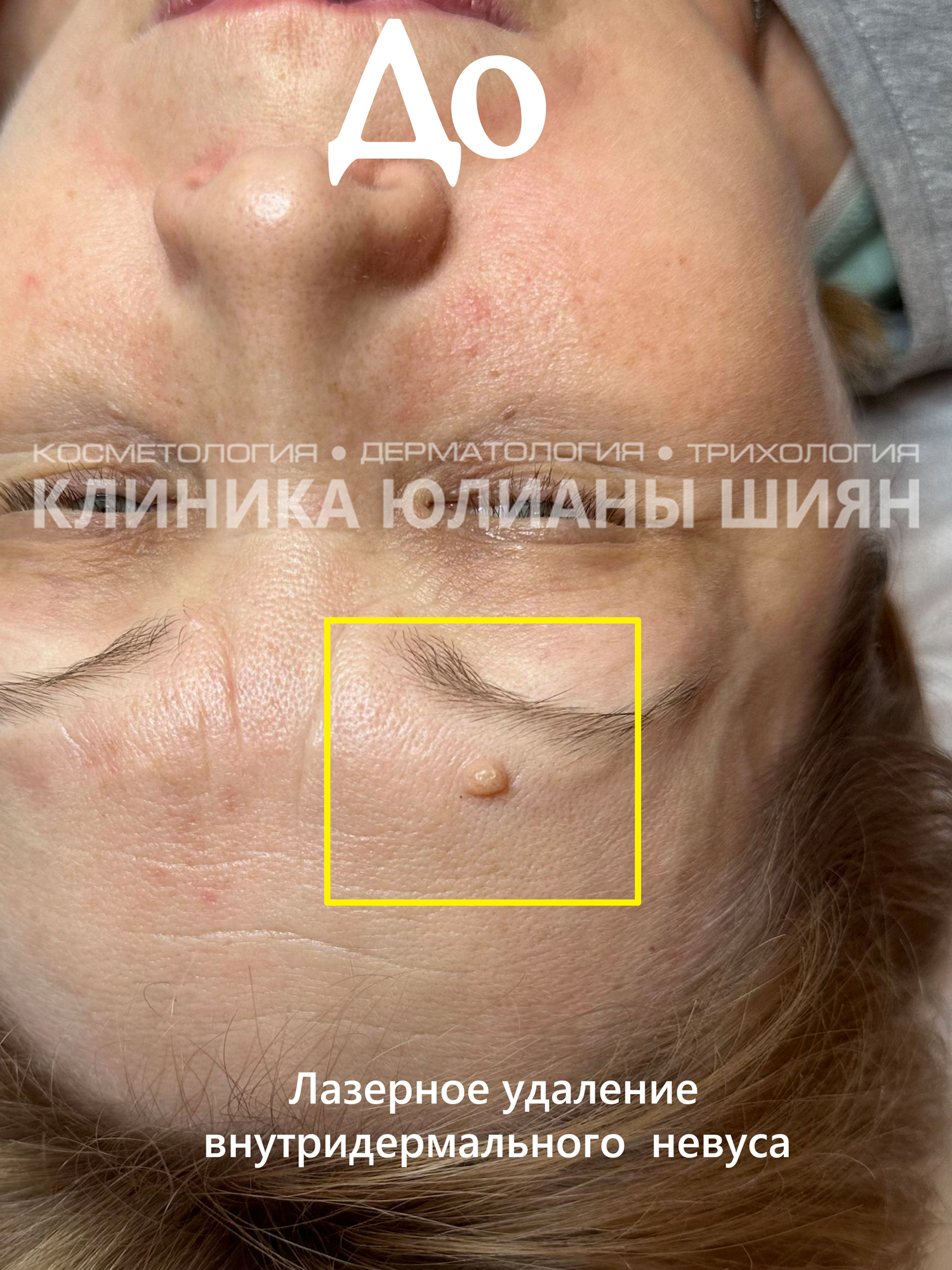 Лазерное удаление внутридермального невуса (до)