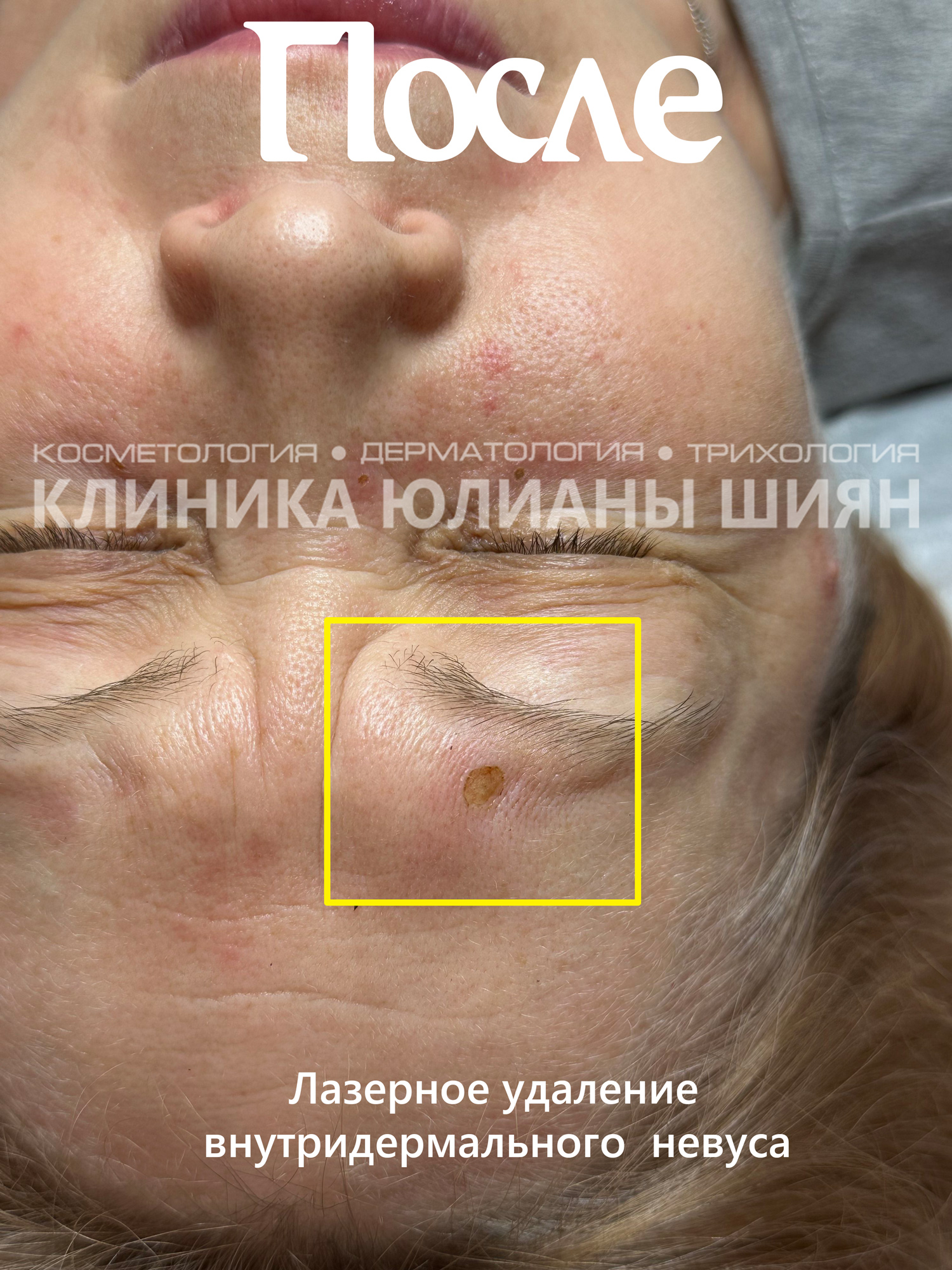 Лазерное удаление внутридермального невуса (после)