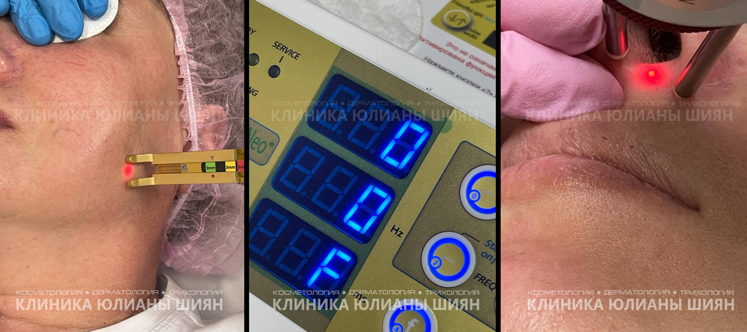 Лечение неодимовым лазером