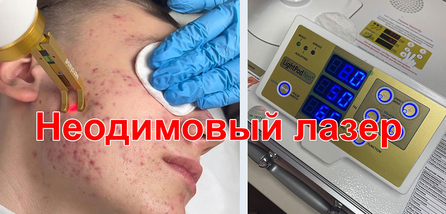 Лечение неодимовым лазером в клинике