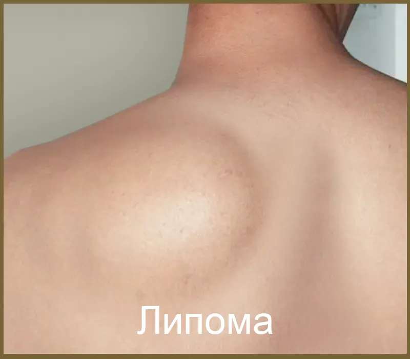 Липома