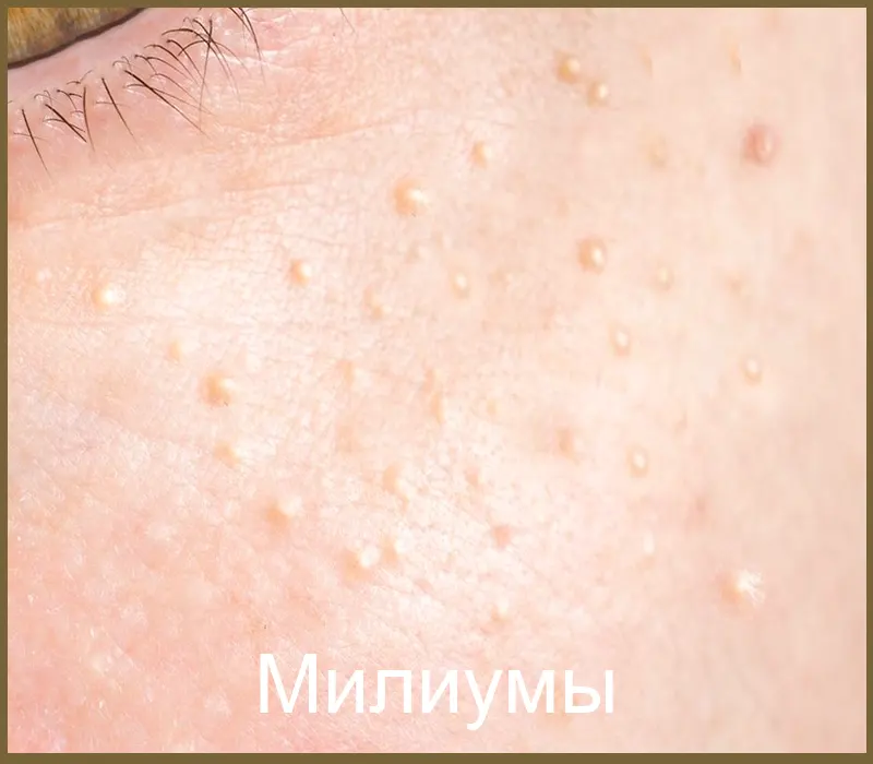 Милиумы