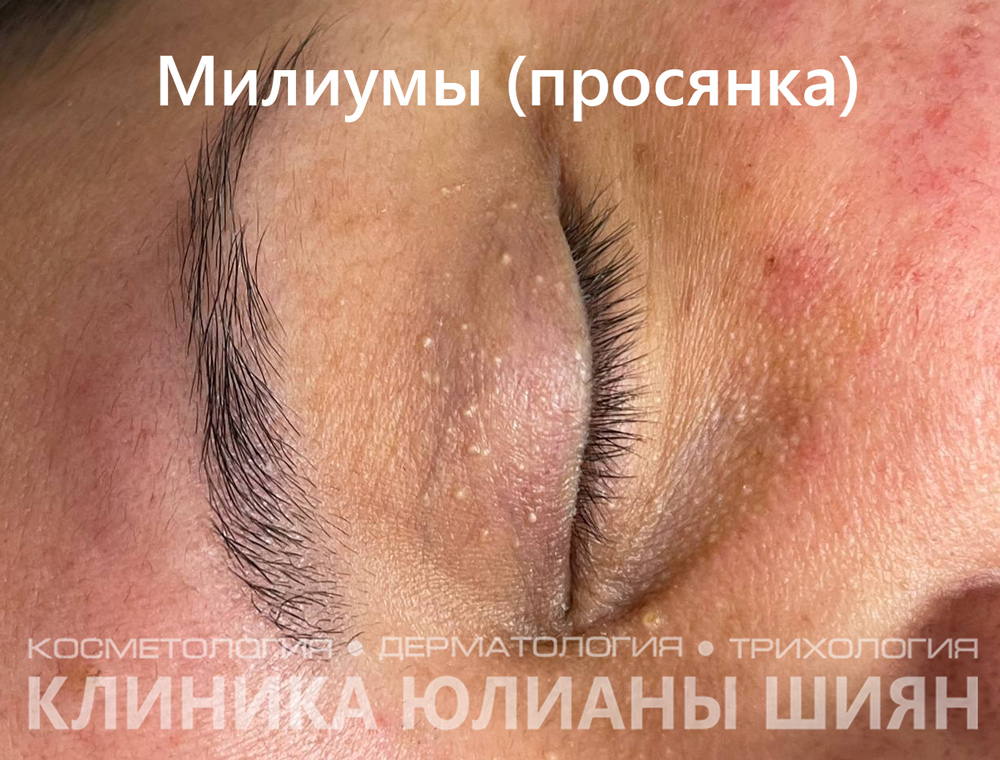 Милиумы (просянка)