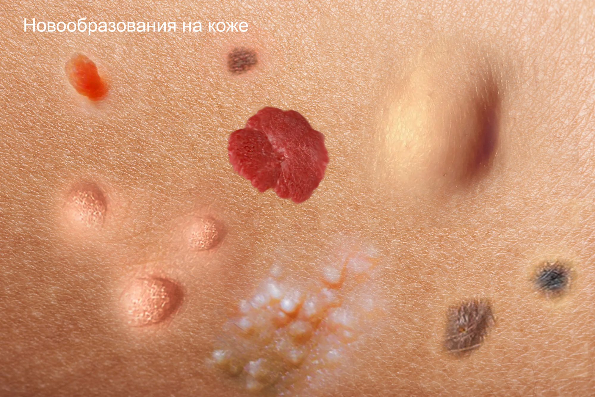 Новообразования на коже