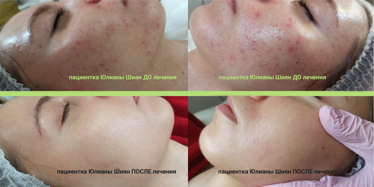 Пациентка Юлианы Шиян, до и после лечения