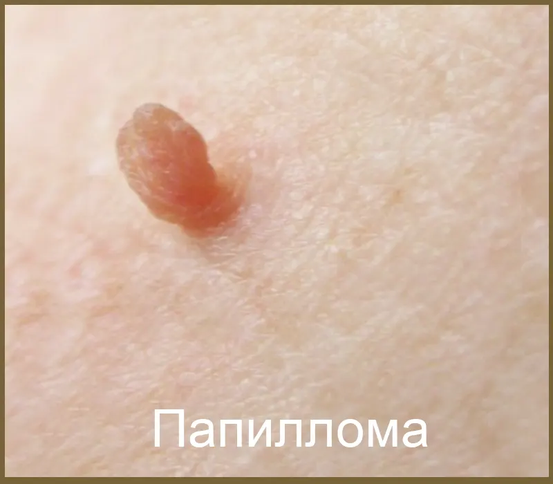 Папиллома