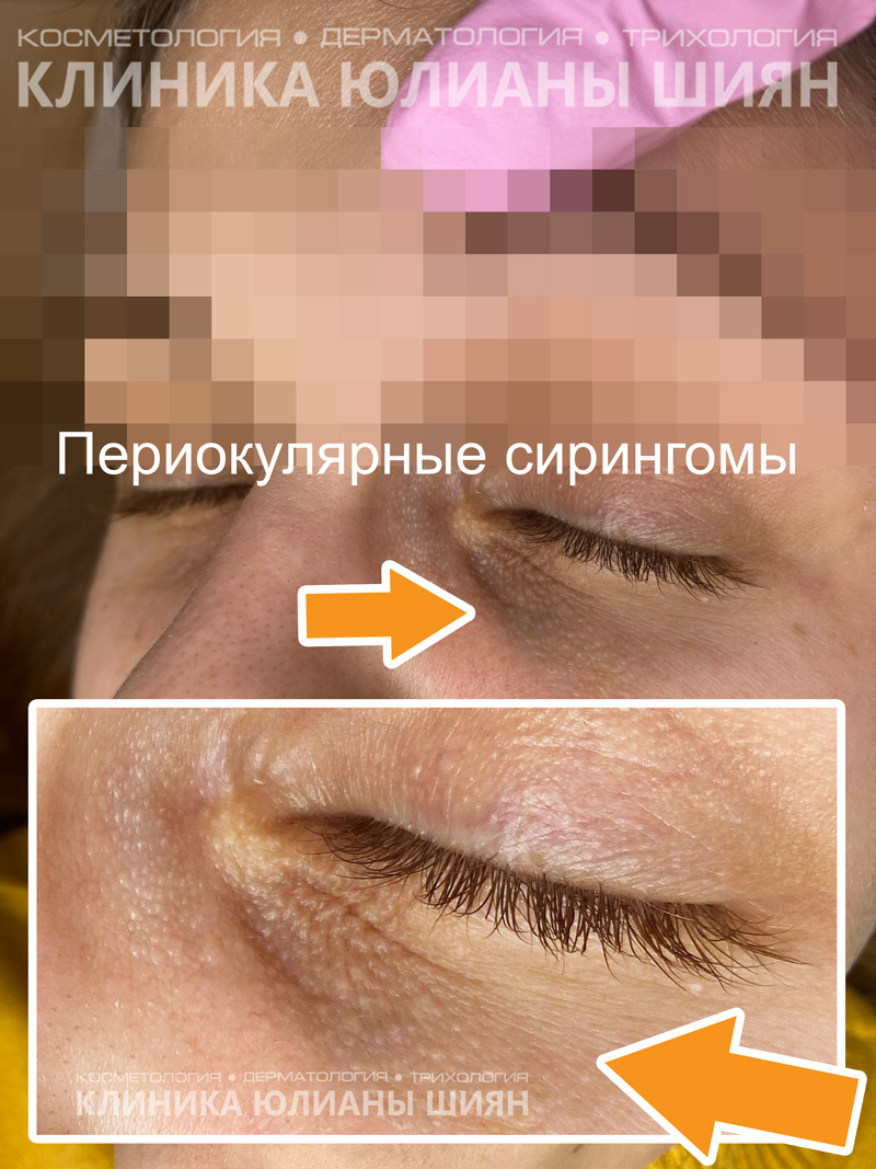 Периокулярные сирингомы