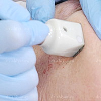 На процедуре РФ лифтинга