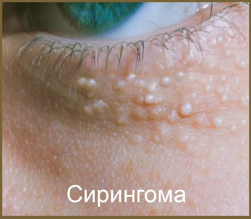 Сирингома