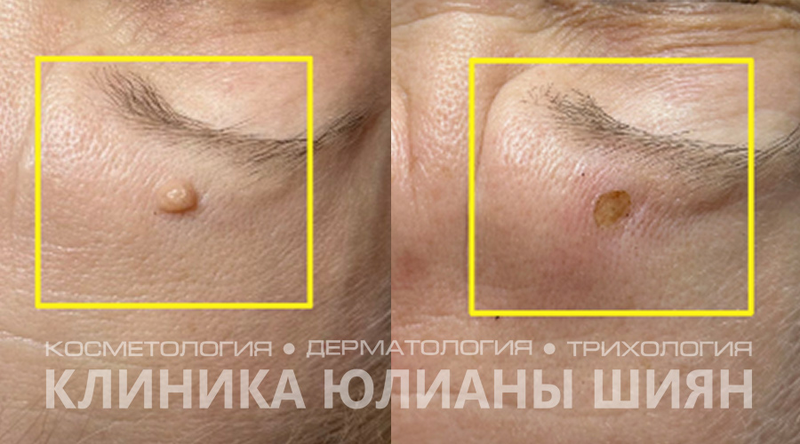 Удаление новообразований лазером